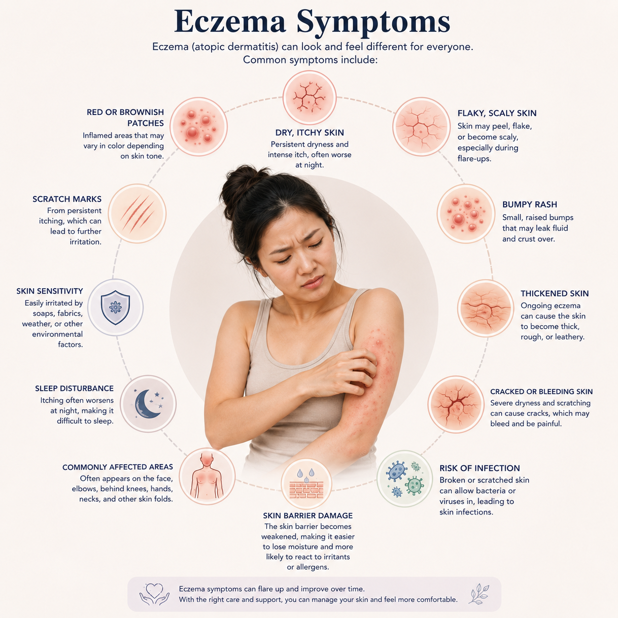 Eczema story